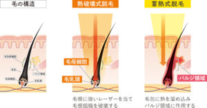 熱破壊式(ショット式)とは？医療脱毛で高い効果を発揮